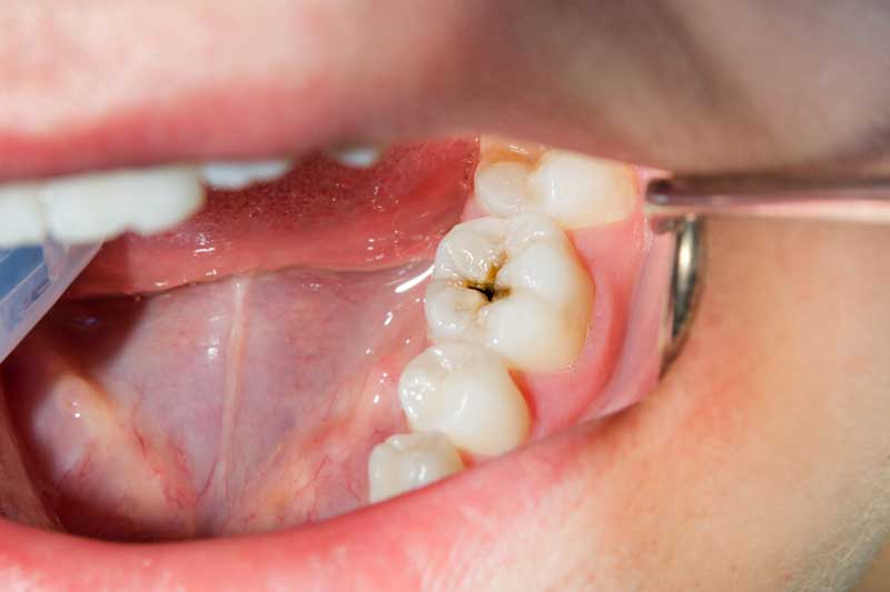 چرا دندان دچار پوسیدگی می شود