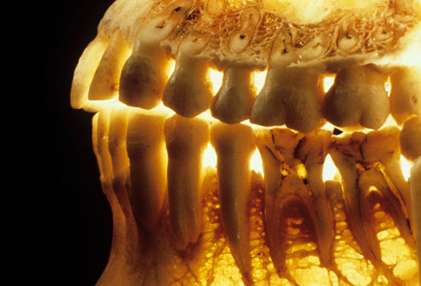 بیماری های دهان و دندان,پوکی استخوان
