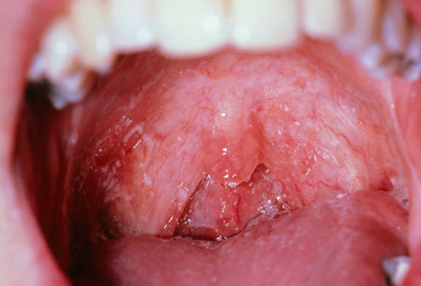بیماری های دهان و دندان,برفک زبان و اچ آی وی
