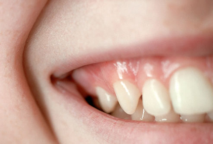 بیماری های دهان و دندان,لثه‌های سالم